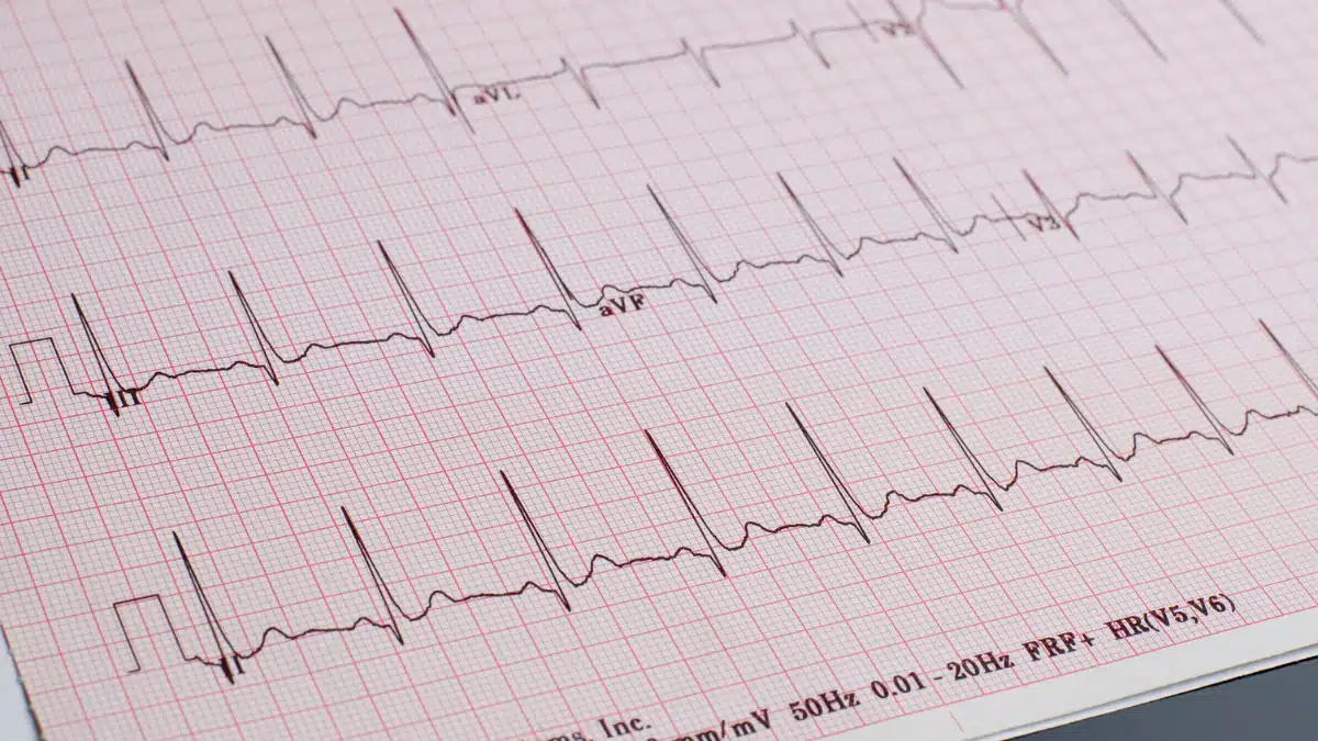 Lista ampla das possíveis alterações observadas no Eletrocardiograma (ECG)