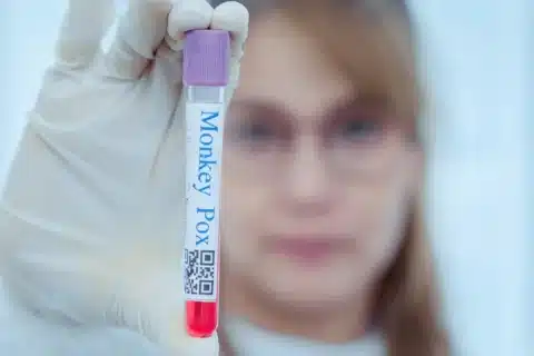 Avanço na Vacina Nacional Contra a Mpox: Um Marco na Autossuficiência Brasileira em Saúde