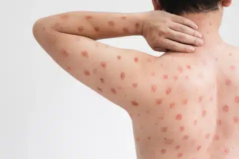 Profissionais de Enfermagem na Linha de Frente Contra a Mpox