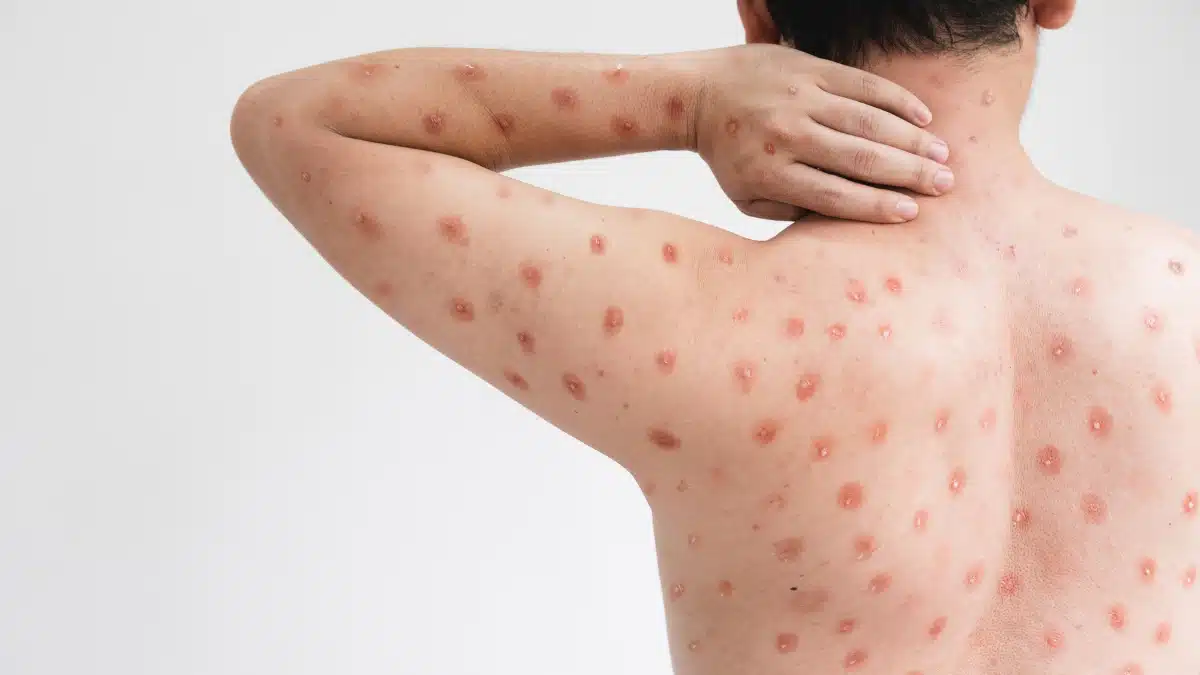 Profissionais de Enfermagem na Linha de Frente Contra a Mpox