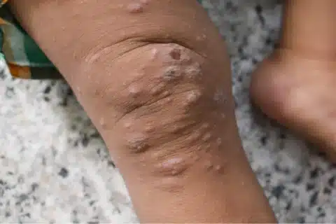 Recomendações Especiais para o Manejo da Monkeypox