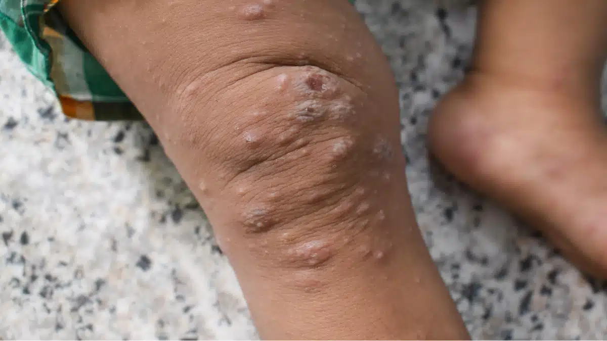 Recomendações Especiais para o Manejo da Monkeypox