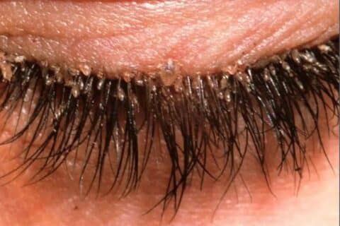 Demodex folliculorum: O ácaro invisível que vive em sua pele