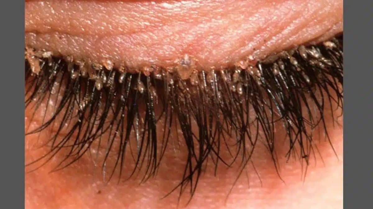 Demodex folliculorum: O ácaro invisível que vive em sua pele