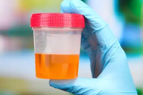 Hematúria: Presença de Sangue na Urina