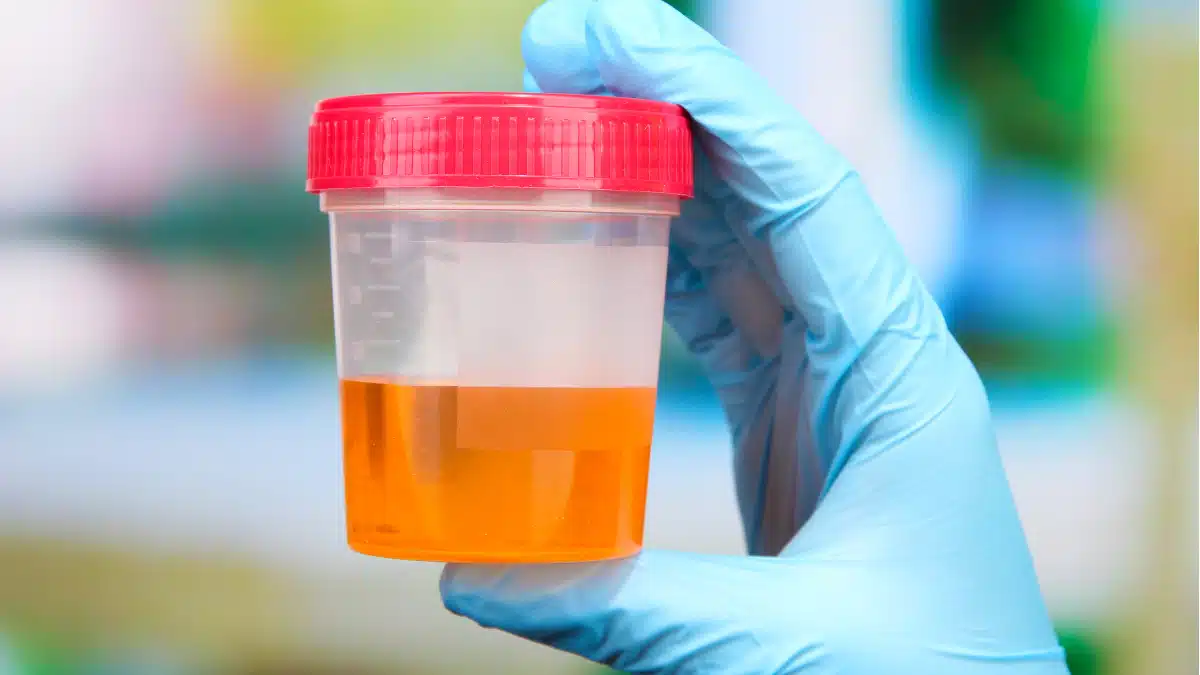 Hematúria: Presença de Sangue na Urina
