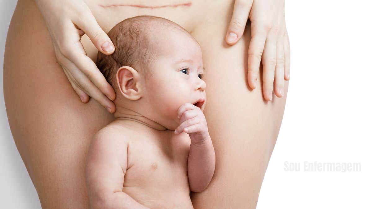 A primeira Cesariana bem-sucedida O início de uma revolução na Obstetrícia (1794)