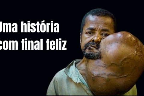 Homem caminha dois dias até Navio-Hospital para remover tumor Gigante no pescoço