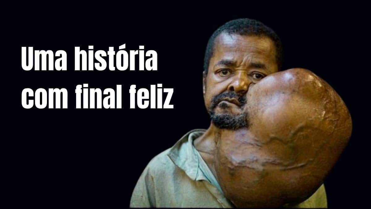 Homem caminha dois dias até Navio-Hospital para remover tumor Gigante no pescoço