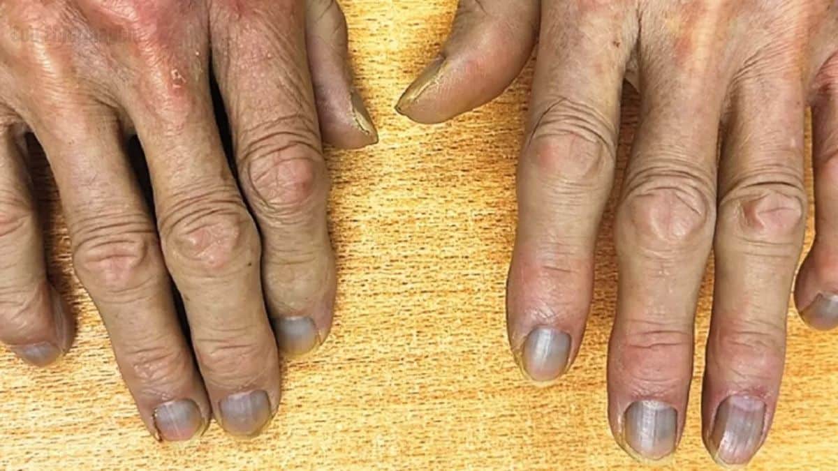 Idoso desenvolve pele cinza e deixa especialistas intrigados