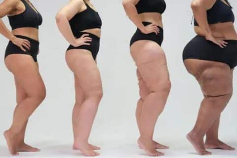 Lipedema a doença que afeta 10% das mulheres e desafia a medicina moderna