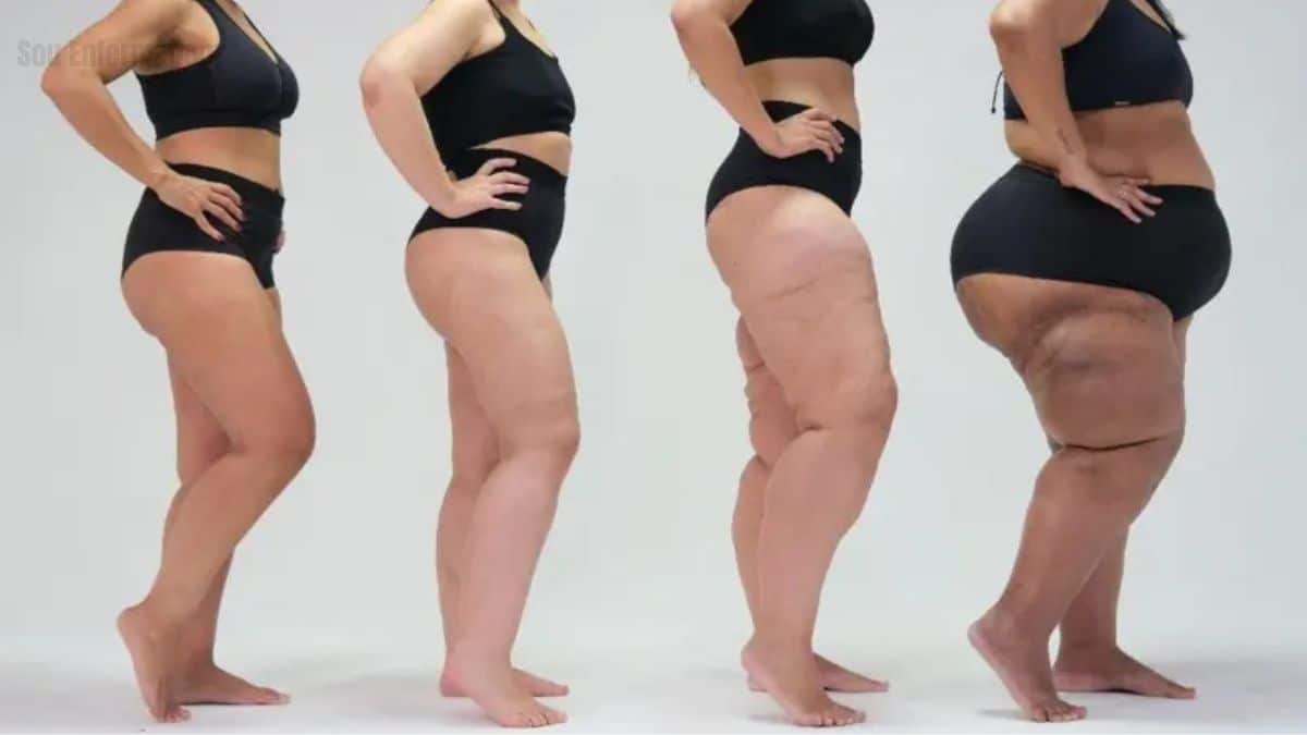 Lipedema a doença que afeta 10% das mulheres e desafia a medicina moderna