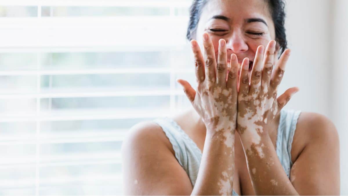 O Vitiligo é uma condição autoimune que acomete diversos artistas e famosos