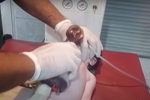 Vídeo mostra prática desesperada para salvar recém-nascido que nasceu sem respirar