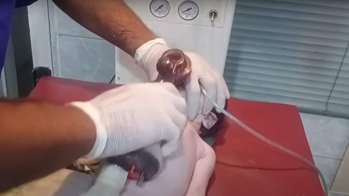 Vídeo mostra prática desesperada para salvar recém-nascido que nasceu sem respirar