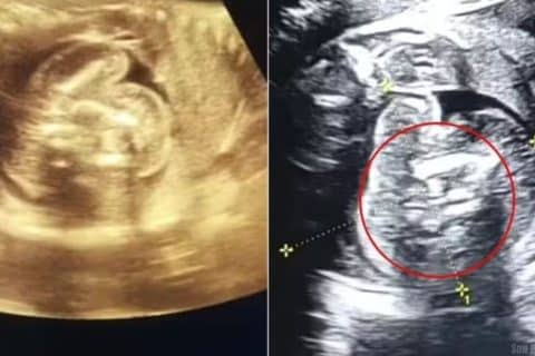 Bebê nasce com dois fetos dentro da barriga em caso médico raríssimo