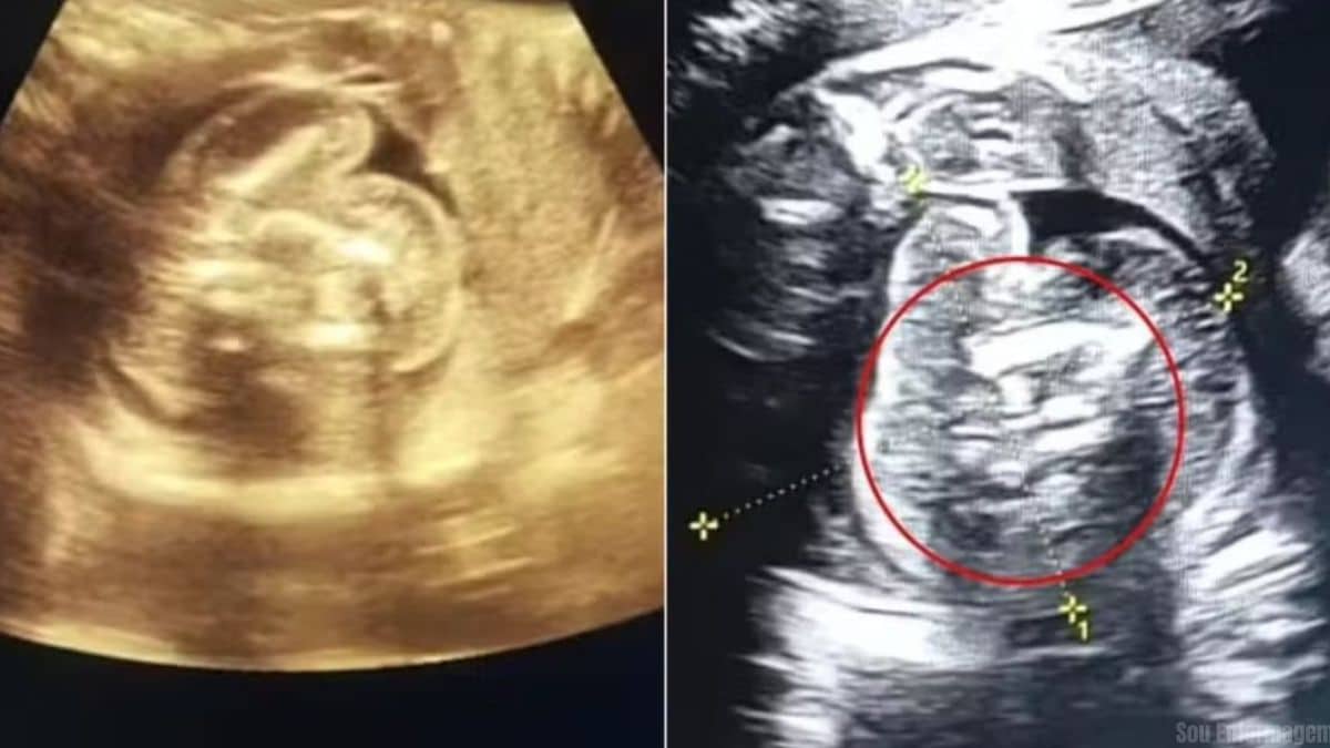 Bebê nasce com dois fetos dentro da barriga em caso médico raríssimo