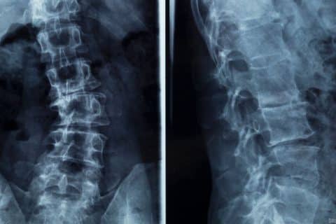 Cirurgias de escoliose no Hospital Infantil de Joinville busca reduzir filas de espera