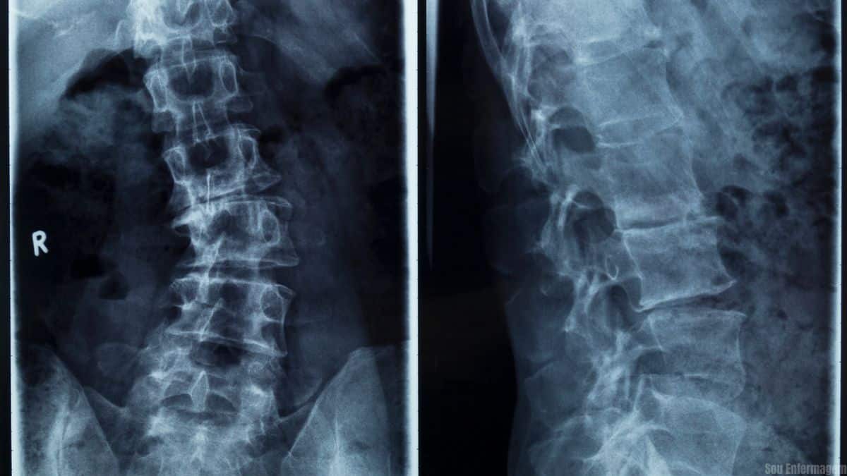 Cirurgias de escoliose no Hospital Infantil de Joinville busca reduzir filas de espera
