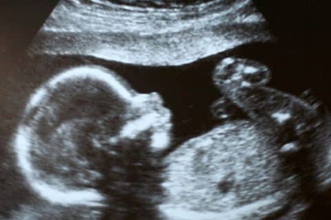 Bebê com doença rara recebe tratamento inovador ainda no útero e nasce saudável