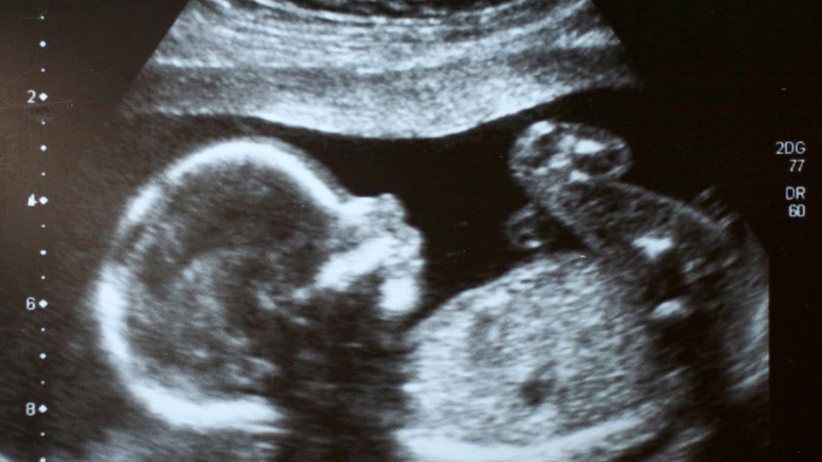 Bebê com doença rara recebe tratamento inovador ainda no útero e nasce saudável
