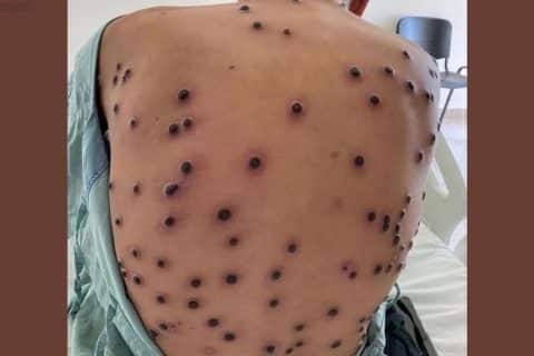 Brasil registra primeiro caso da nova cepa de mpox e acende alerta para vigilância epidemiológica