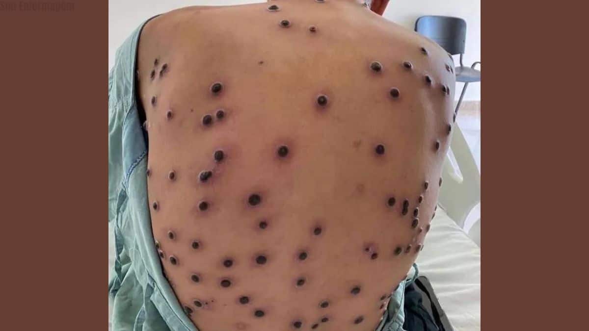 Brasil registra primeiro caso da nova cepa de mpox e acende alerta para vigilância epidemiológica