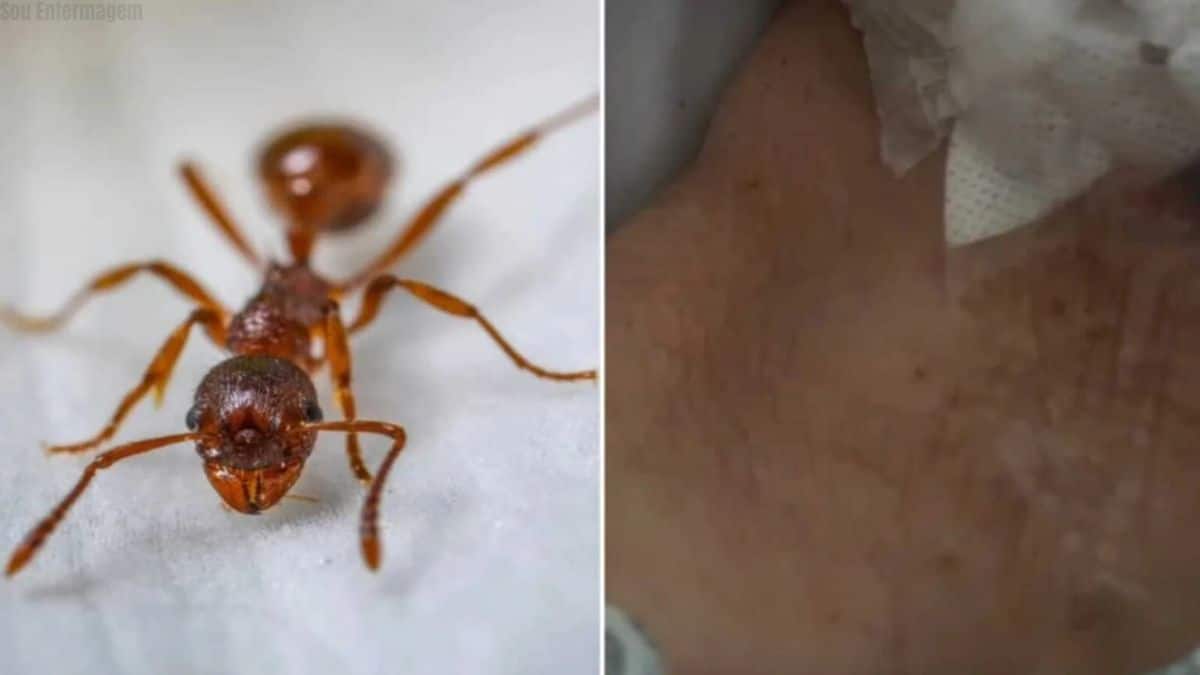 Idosa é picada por dezenas de formigas enquanto estava internada em hospital particular de Sorocaba