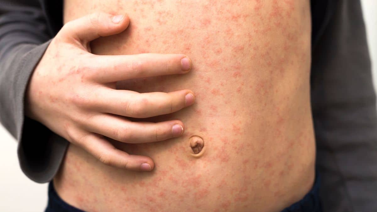 Surto global de sarampo reacende alerta sobre vacinação e saúde pública