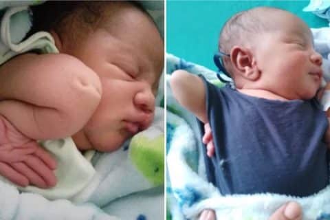 Bebê nasce com condição rara nos braços e desafia prognósticos médicos desde o parto