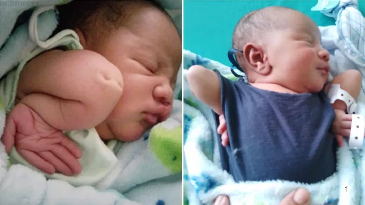 Bebê nasce com condição rara nos braços e desafia prognósticos médicos desde o parto