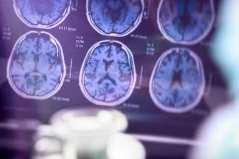 Exame de sangue para Alzheimer quando vale a pena fazer