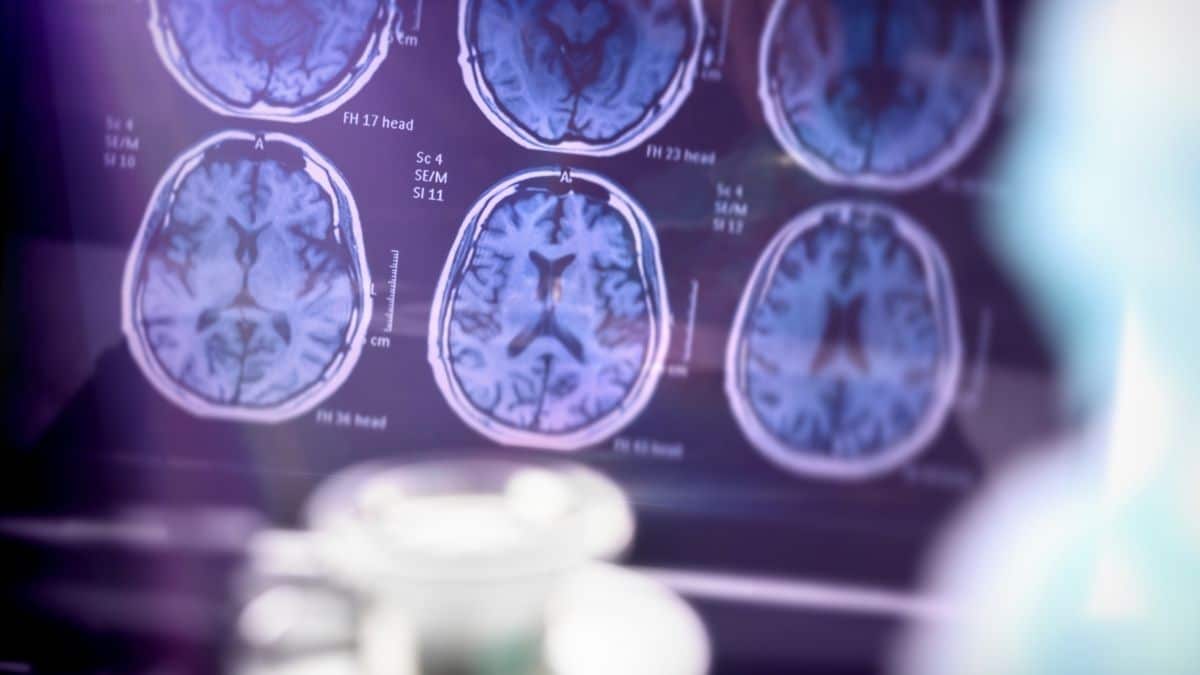 Exame de sangue para Alzheimer quando vale a pena fazer