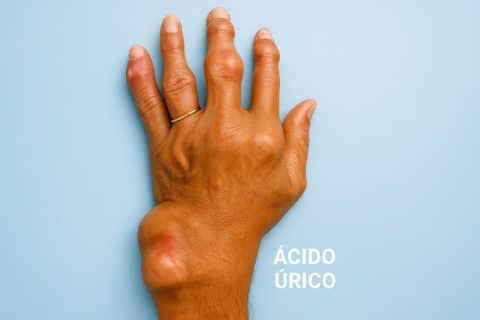 Gota e ácido úrico: sintomas, causas, prevenção e tratamento