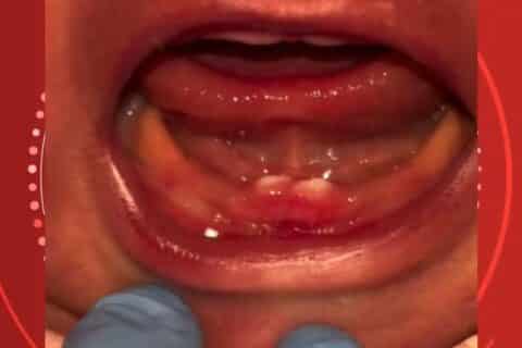 Bebê nasce com dentes e passa por cirurgia nos primeiros dias de vida