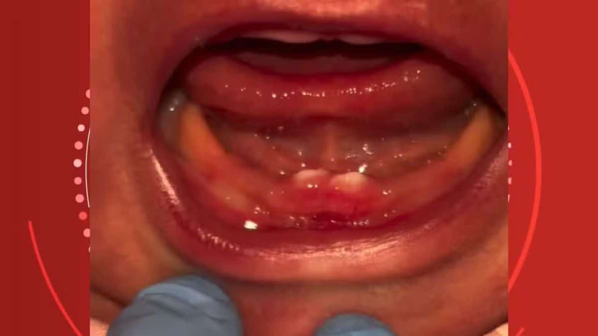 Bebê nasce com dentes e passa por cirurgia nos primeiros dias de vida