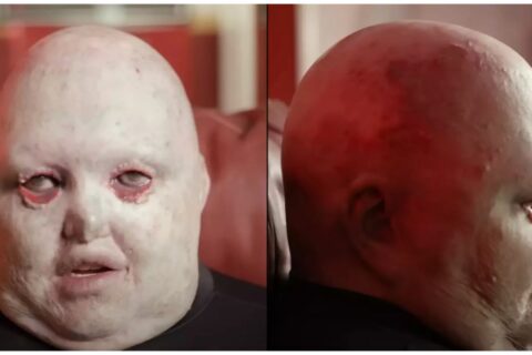 Dean Clifford a história do homem com epidermólise bolhosa que “quebrou as regras” e virou símbolo de resistência