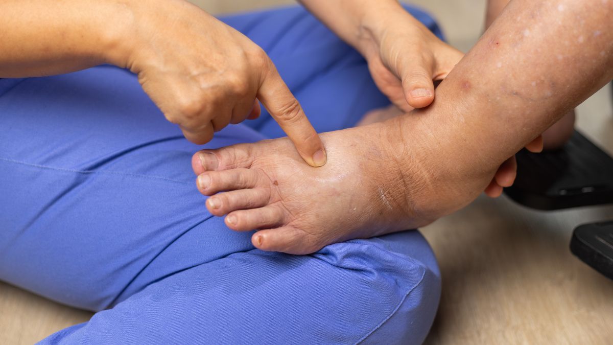 Lipedema: o que são os gatilhos inflamatórios da doença crônica reconhecida pela OMS