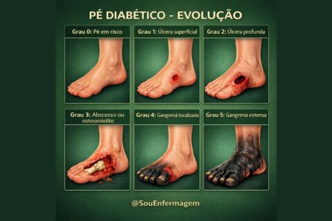 Pé Diabético evolução, estágios clínicos e a importância da prevenção