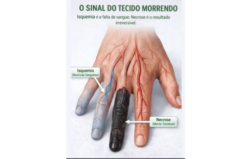 Isquemia e Necrose: como identificar os sinais de “tecido morrendo” e o que fazer diante do risco