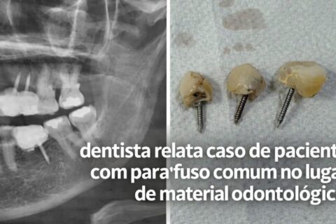 Não era implante”: dentista relata caso de paciente com parafuso comum no lugar de material odontológico