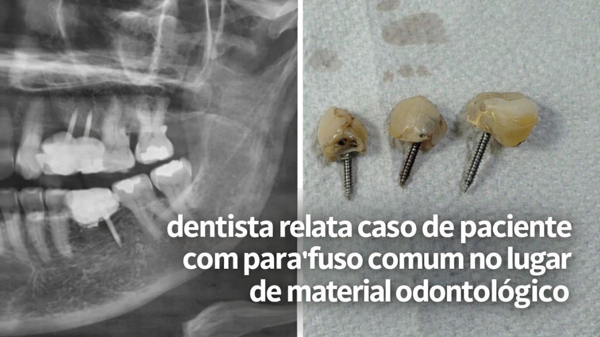Não era implante”: dentista relata caso de paciente com parafuso comum no lugar de material odontológico