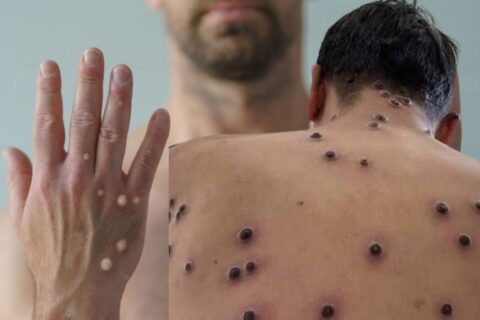 Nova variante recombinante de mpox é confirmada e acende alerta para vigilância