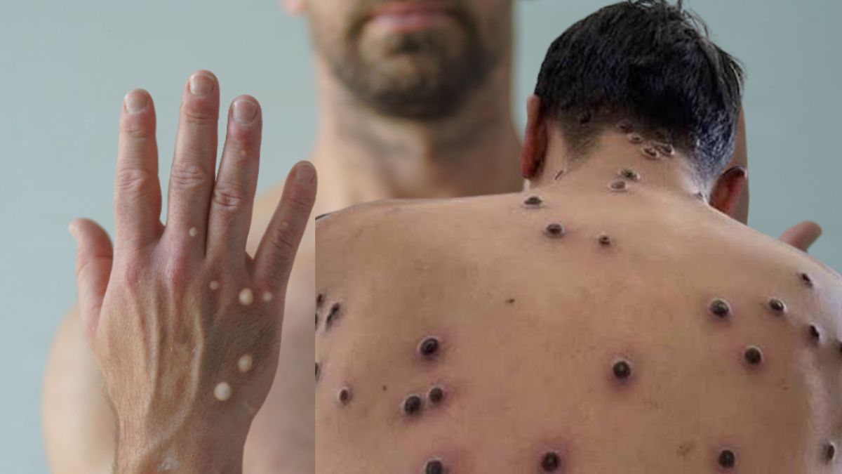 Nova variante recombinante de mpox é confirmada e acende alerta para vigilância