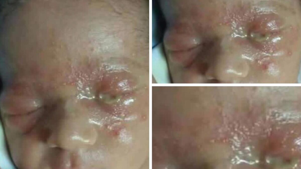 Olho grudado no recém-nascido pode indicar conjuntivite neonatal; entenda sinais de alerta e cuidados