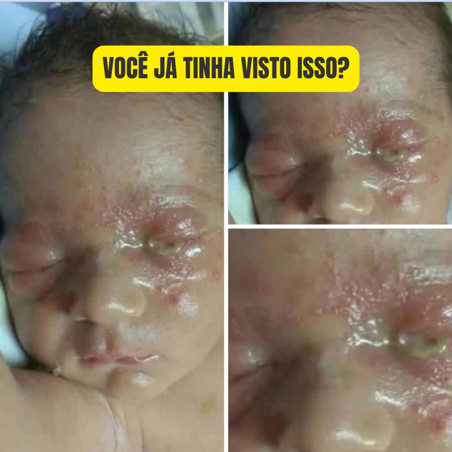 Olho grudado no recém-nascido pode indicar conjuntivite neonatal ...