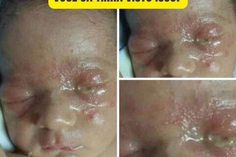 Olho grudado no recém-nascido pode indicar conjuntivite neonatal; entenda sinais de alerta e cuidados