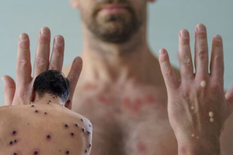 Paraná confirma primeiro caso de mpox em 2026; paciente procurou atendimento em Foz do Iguaçu