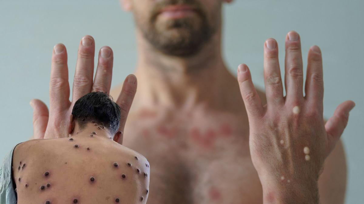 Paraná confirma primeiro caso de mpox em 2026; paciente procurou atendimento em Foz do Iguaçu
