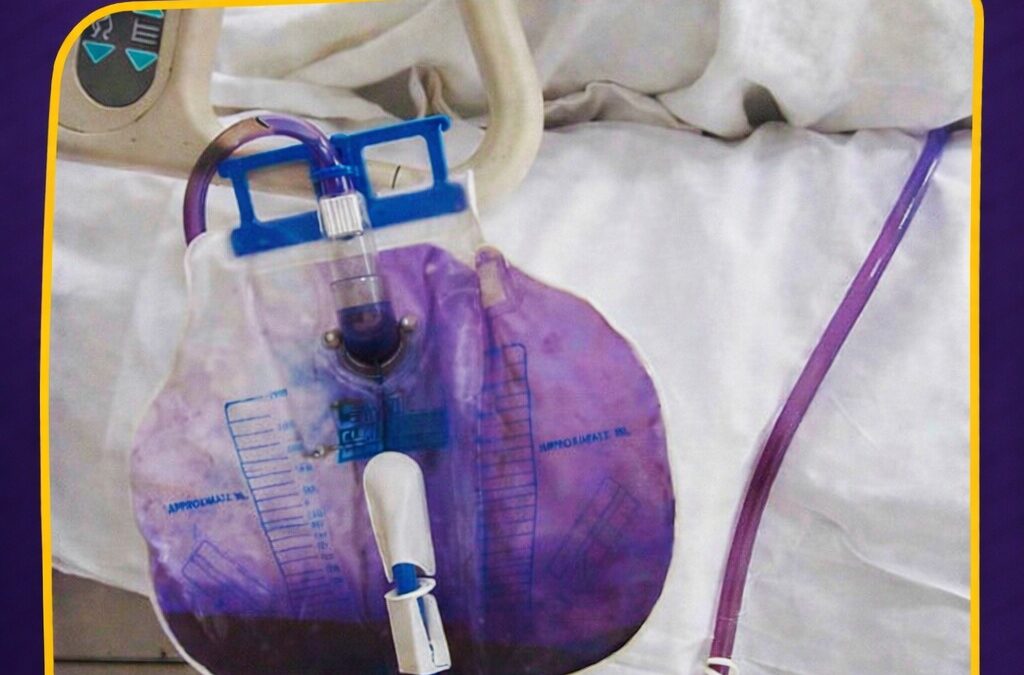 Urina roxa na bolsa coletora chama atenção e pode indicar infecção urinária associada a sonda